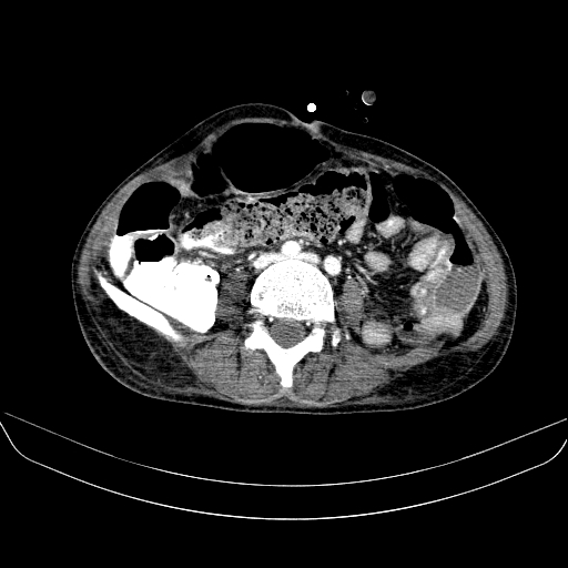 File:Abdominal collection due to previous cecal perforation (Radiopaedia 80831-94320 Axial C+ portal venous phase 122).jpg