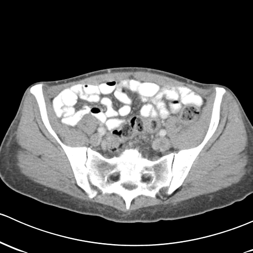 File:Abdominal desmoid tumor (Radiopaedia 41007-43740 Axial C+ portal venous phase 54).png