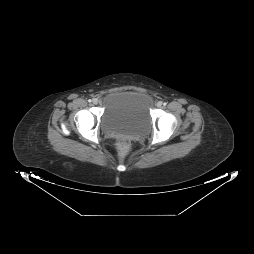 Abdominal gossypiboma- surgical towel (Radiopaedia 57288-64226 Axial C+ portal venous phase 69).jpg