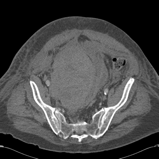 File:Abdominal hematoma (Radiopaedia 33614-34715 Axial C+ portal venous phase 104).png