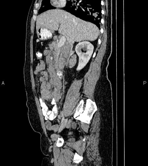 Abdominal lymphoma with sandwich sign (Radiopaedia 84378-99704 Sagittal C+ portal venous phase 31).jpg