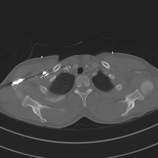 File:Abdominal multi-trauma - devascularised kidney and liver, spleen and pancreatic lacerations (Radiopaedia 34984-36486 I 14).png