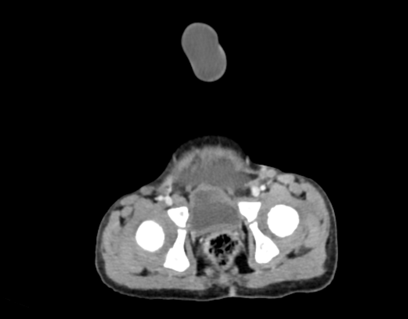 Abdominal premesenteric cystic lymphangioma (Radiopaedia 82995-97350 Axial C+ portal venous phase 65).jpg