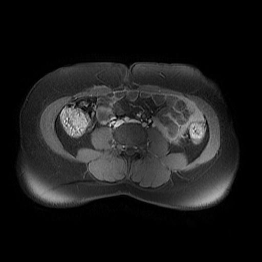 File:Abdominal wall endometriosis (Radiopaedia 83702-98847 Axial T1 C+ fat sat 11).jpg
