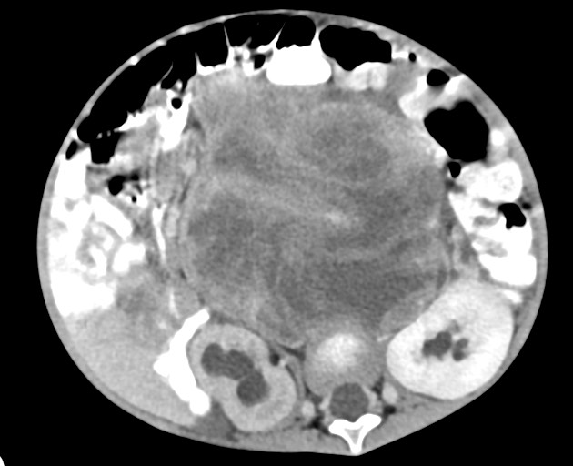 Abdominopelvic rhabdomyosarcoma (Radiopaedia 78356-90984 Axial C+ portal venous phase 87).jpg