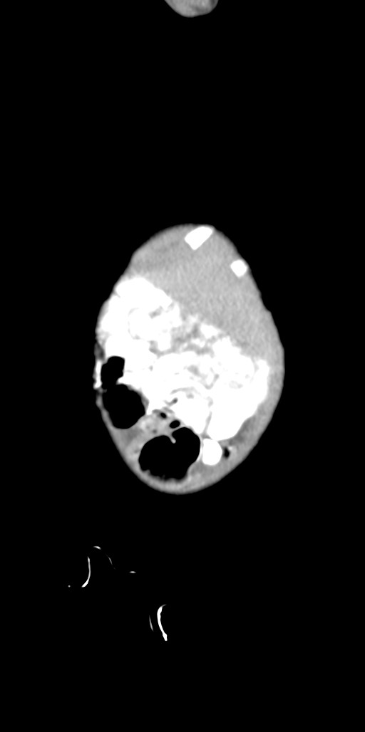 Abdominopelvic rhabdomyosarcoma (Radiopaedia 78356-90984 Sagittal C+ portal venous phase 95).jpg