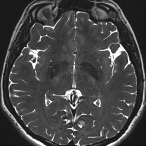 Abducens nerve palsy (Radiopaedia 51069-56648 Axial T2 fat sat 90).png