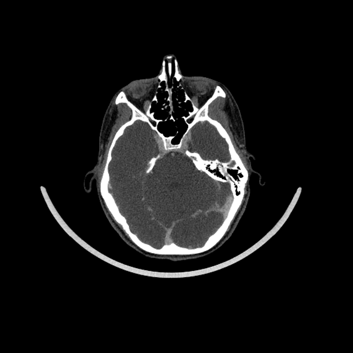 Aberrant right internal carotid artery (Radiopaedia 65191-74197 Axial C+ arterial phase 14).jpg