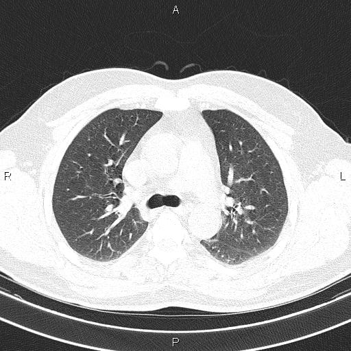 File:Aberrant right subclavian artery (Radiopaedia 87093-103354 Axial lung window 41).jpg