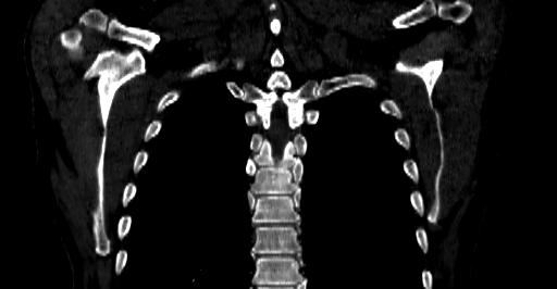 Accesory rib joint (Radiopaedia 71987-82452 Coronal bone window 50).jpg