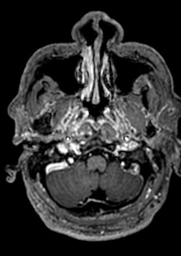 Accessory middle cerebral artery (Radiopaedia 73114-83828 Axial T1 C+ 169).jpg