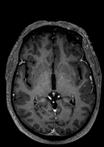 Accessory middle cerebral artery (Radiopaedia 73114-83828 Axial T1 C+ 43).jpg