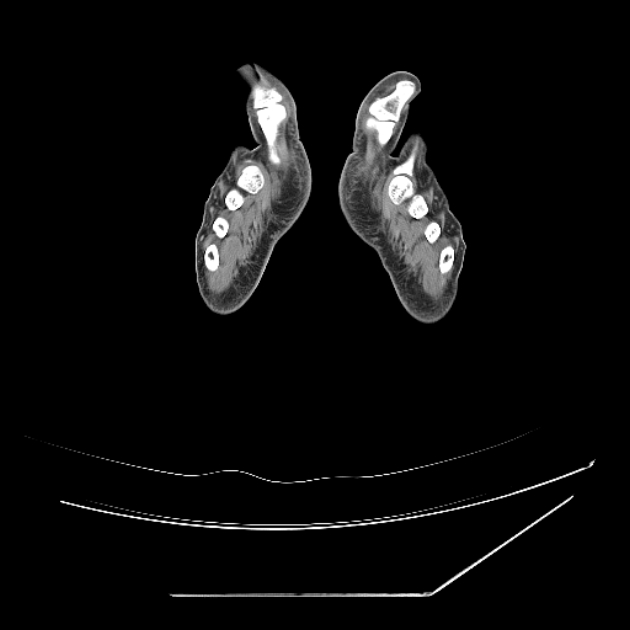 Accessory soleus muscle (Radiopaedia 61069-68943 Axial non-contrast 98).jpg