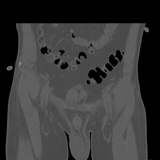 Acetabular and ilial fractures (Radiopaedia 59084-66378 Coronal bone window 8).jpg