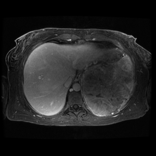 Acinar cell carcinoma of the pancreas (Radiopaedia 75442-86668 D 117).jpg