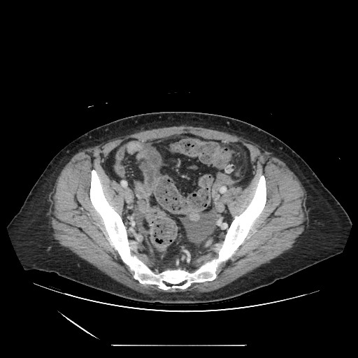 Acinar cell carcinoma of the pancreas (Radiopaedia 75442-86669 Axial C+ portal venous phase 121).jpg