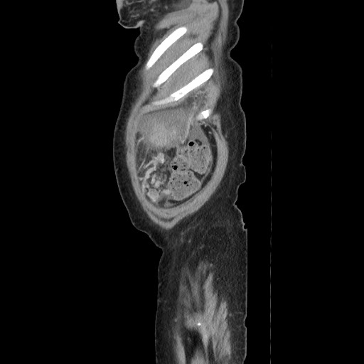 Acinar cell carcinoma of the pancreas (Radiopaedia 75442-86669 Sagittal C+ portal venous phase 177).jpg