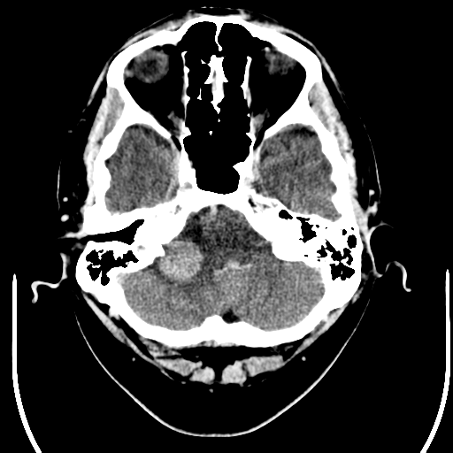 File:Acoustic schwannoma (Radiopaedia 39170-41389 Axial C+ 5).png
