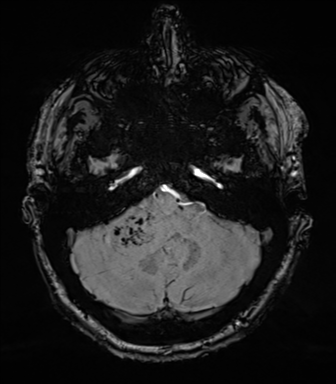 Acoustic schwannoma (Radiopaedia 50846-56358 Axial SWI 21).png