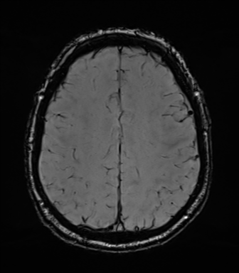 File:Acoustic schwannoma (Radiopaedia 50846-56358 Axial SWI 69).png