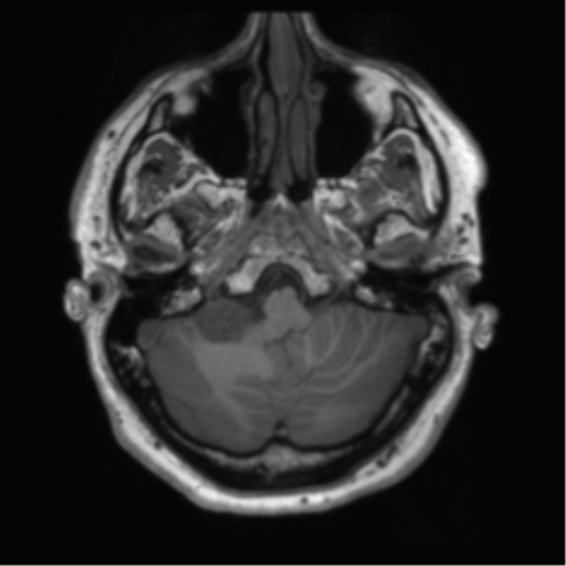 File:Acoustic schwannoma (Radiopaedia 50846-56358 Axial T1 11).png