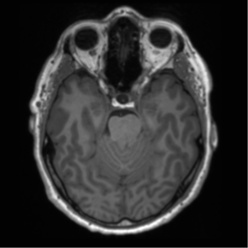 File:Acoustic schwannoma (Radiopaedia 50846-56358 Axial T1 37).png