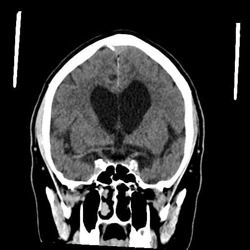 File:Acoustic schwannoma (Radiopaedia 55729-62280 Coronal non-contrast 18).png