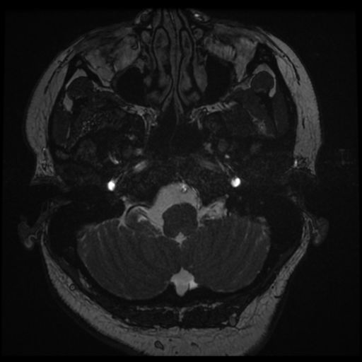 Acoustic schwannoma (Radiopaedia 57574-64536 Axial T2 7).png