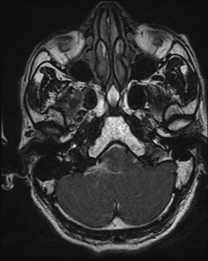 Acoustic schwannoma - probable (Radiopaedia 20386-20292 Axial T1 26).jpg