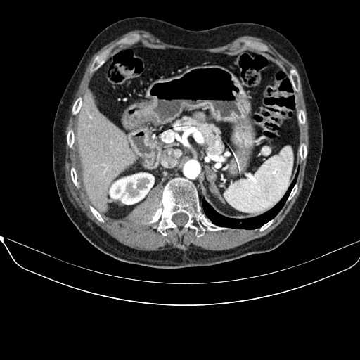 File:Acquired adrenal hyperplasia - due to thymic carcinoid tumor (Radiopaedia 21269-21184 C+ arterial phase 31).jpg