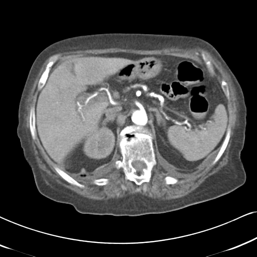 File:Active bleeding from duodenal ulcer with embolization (Radiopaedia 34216-35481 Axial C+ arterial phase 19).png