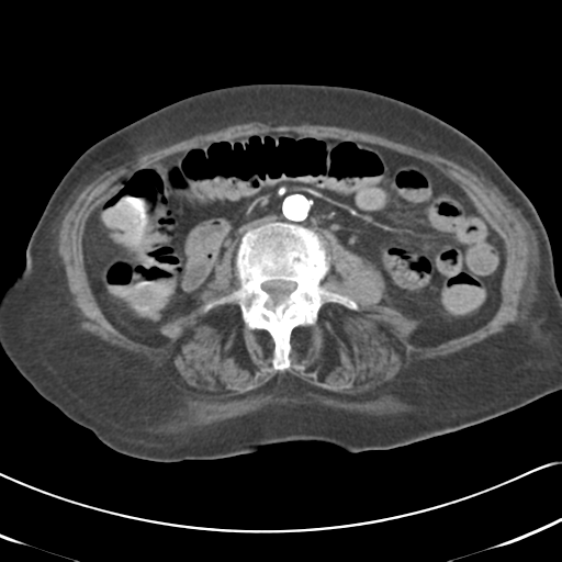 File:Active bleeding from duodenal ulcer with embolization (Radiopaedia 34216-35481 Axial C+ arterial phase 32).png