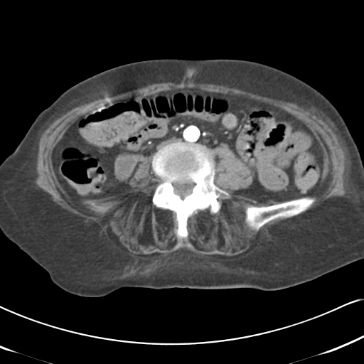 File:Active bleeding from duodenal ulcer with embolization (Radiopaedia 34216-35481 Axial C+ arterial phase 37).png