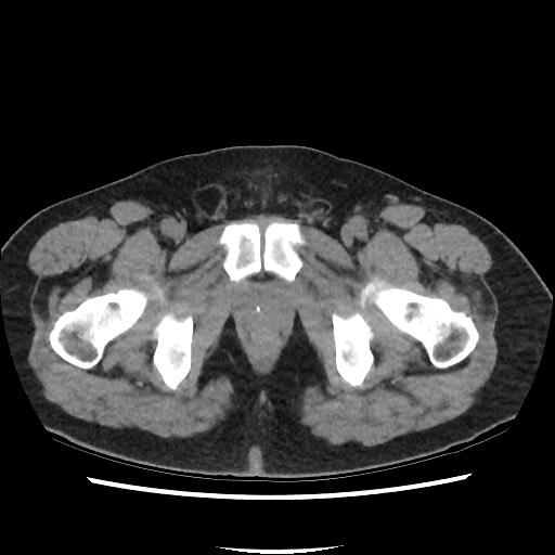 Active colonic bleed on CT (Radiopaedia 49765-55025 Axial non-contrast 85).jpg
