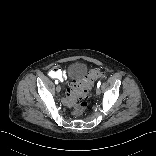 File:Active lower gastrointestinal bleeding - diverticular (Radiopaedia 61203-69106 Axial C+ arterial phase 52).jpg