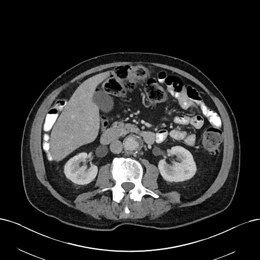 File:Active lower gastrointestinal bleeding - diverticular (Radiopaedia 61203-69106 Axial C+ portal venous phase 58).jpg