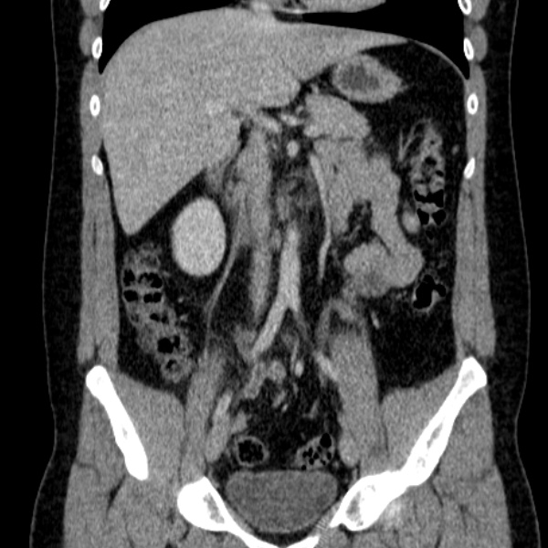 File:Acute appendicitis (Radiopaedia 38255-40270 Coronal C+ portal venous phase 42).jpg