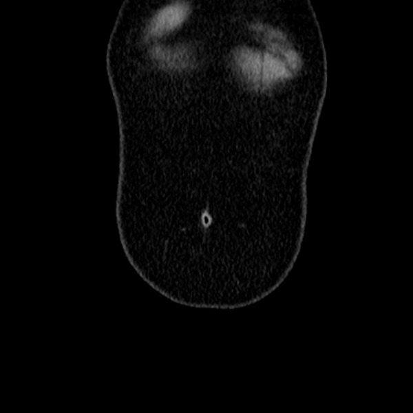 Acute appendicitis (Radiopaedia 38255-40270 Coronal C+ portal venous phase 7).jpg