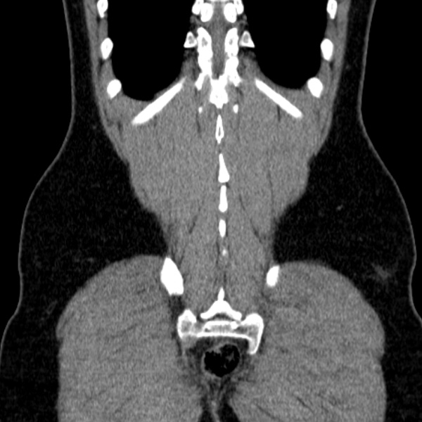 File:Acute appendicitis (Radiopaedia 38255-40270 Coronal C+ portal venous phase 76).jpg