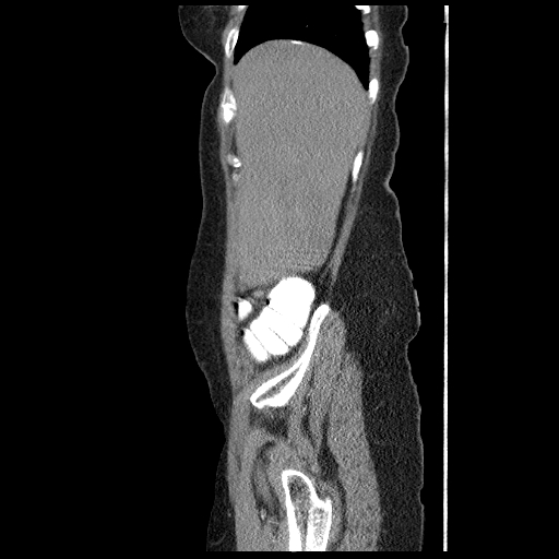 File:Acute appendicitis (Radiopaedia 52672-58589 Sagittal C+ arterial phase 12).jpg