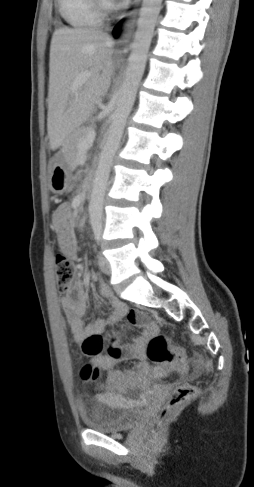 Acute appendicitis (Radiopaedia 62608-70901 Sagittal C+ portal venous phase 14).jpg