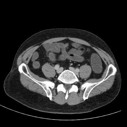 Acute appendicitis (Radiopaedia 66513-75790 Axial C+ portal venous phase 61).jpg