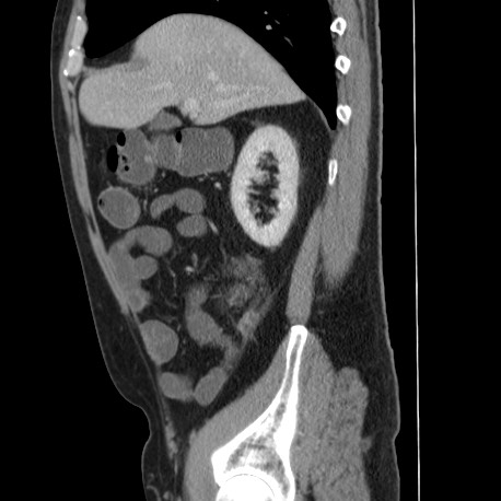 File:Acute appendicitis (Radiopaedia 66513-75790 Sagittal C+ portal venous phase 44).jpg