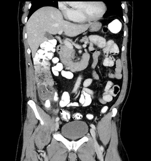 File:Acute appendicitis (Radiopaedia 77016-88960 Coronal C+ portal venous phase 45).jpg