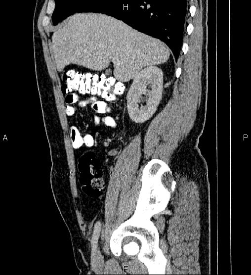 Acute appendicitis (Radiopaedia 84780-100240 Sagittal C+ portal venous phase 30).jpg
