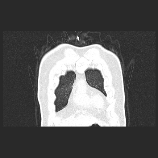 Acute appendicitis and COVID 19 pneumonia (Radiopaedia 76604-88380 G 10).jpg