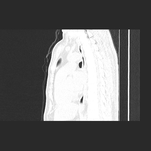 Acute appendicitis and COVID 19 pneumonia (Radiopaedia 76604-88380 Sagittal lung window 52).jpg