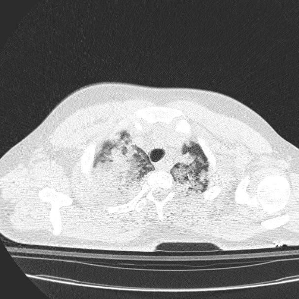 Acute aspiration pneumonitis (Radiopaedia 33605-34703 Axial lung window 20).jpg