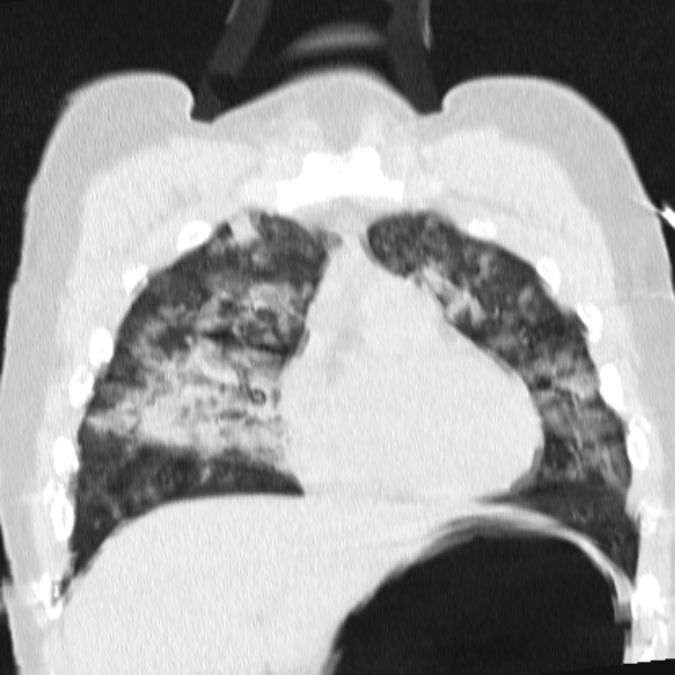 Acute aspiration pneumonitis (Radiopaedia 33605-34703 Coronal lung window 30).jpg