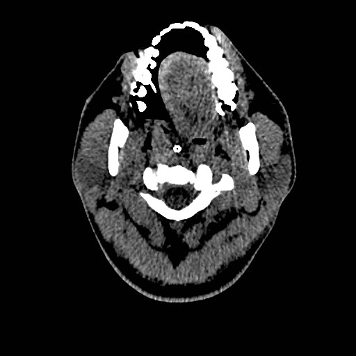 Acute basilar artery occlusion (Radiopaedia 43582-46985 Axial non-contrast 10).jpg